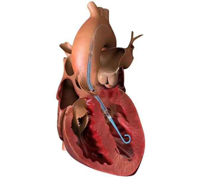 Impella CP with SmartAssist (임팰라CP) 
