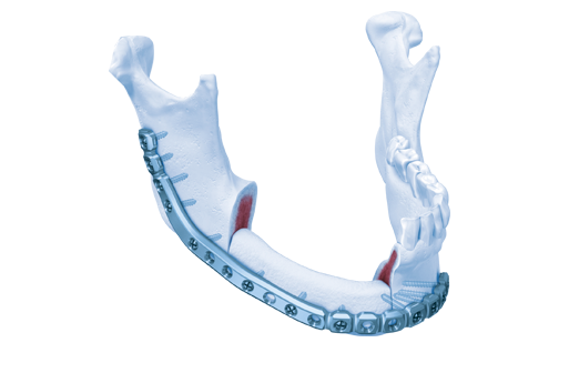 MatrixMANDIBLE™ System