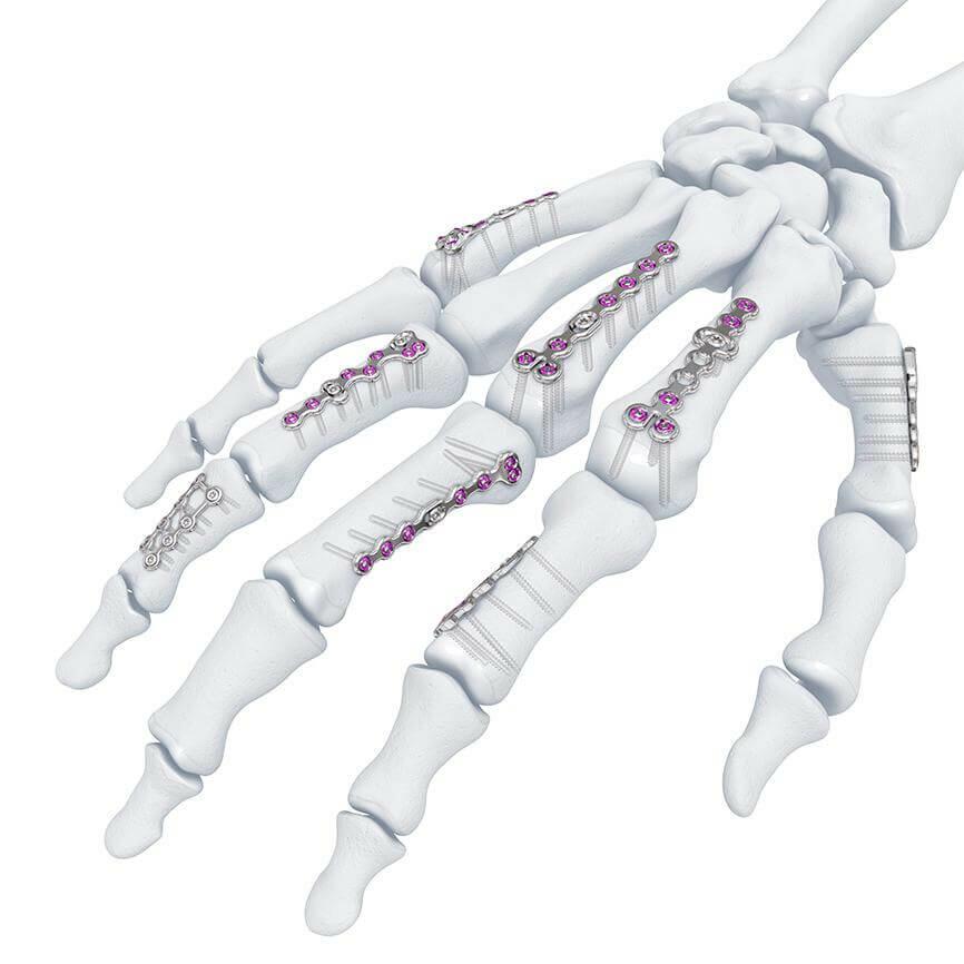 Variable Angle Locking Hand System