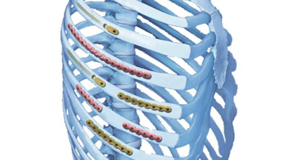 MatrixRIB® Fixation System