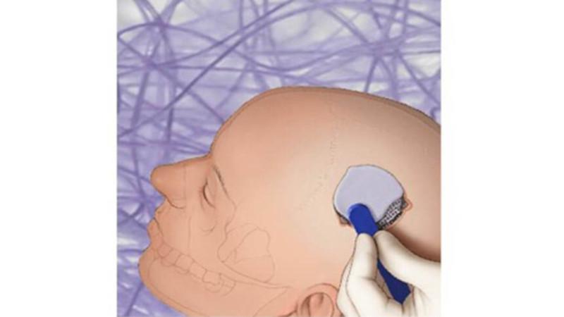 CRANIOS REINFORCED® Fast Set Putty and Rotary Mix