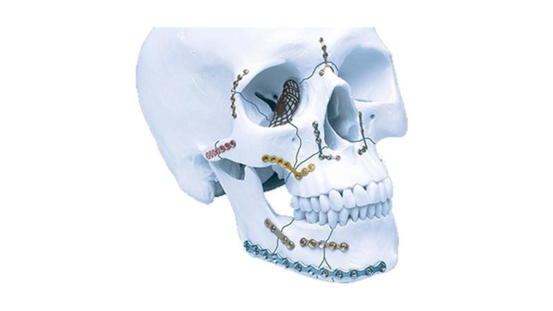 Example of Maxillofacial Mandible Fracture Fixation and Reconstruction procedure