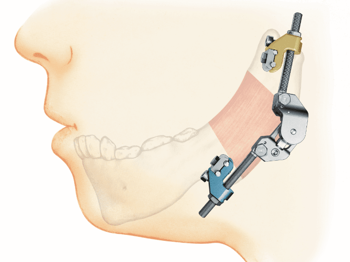 Titanium Multi-Vector Distractor System