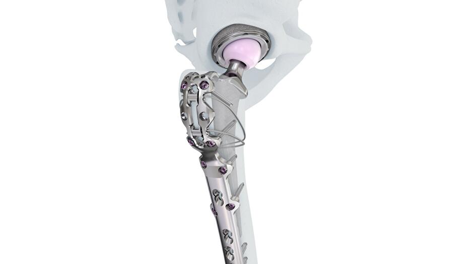 VA LCP™ Periprosthetic Proximal Femur Plating System​