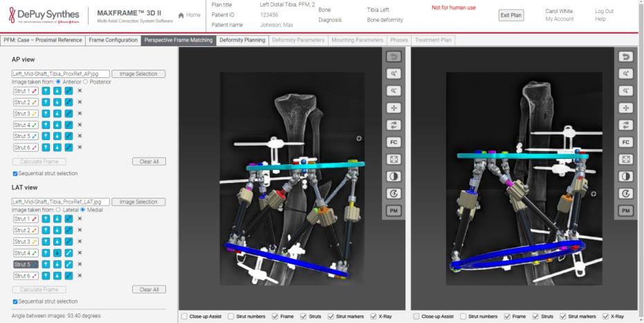 MAXFRAME Software Multi-Axial Correction System displaying Perspective Frame Matching from AP view and LAT view