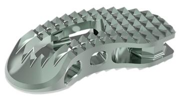 image of T-Pal implant