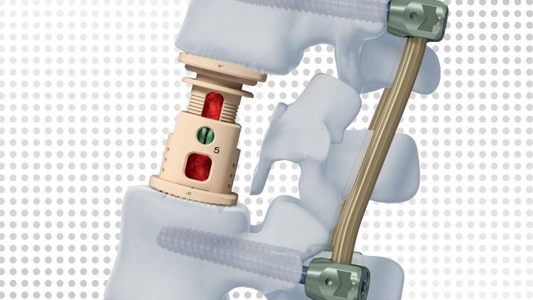 Image of XRL vertebral body replacement system situated inside of the spinal column