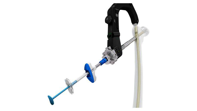 TRAUMACEM V+ System attached to bone 