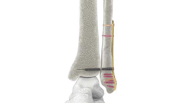 Picture with tibia screw inserted