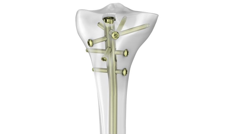 TN-ADVANCED System inside of bone