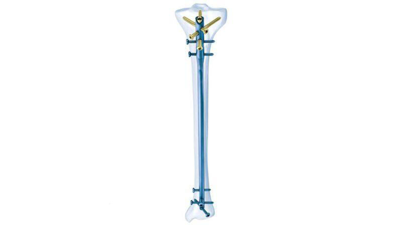 Ti cannulated tibial nail