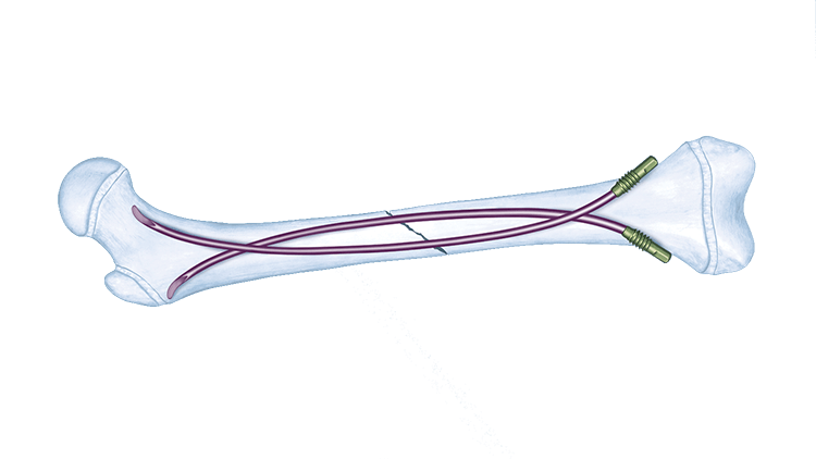 Titanium Elastic Nail (TEN™) System shown in a bone