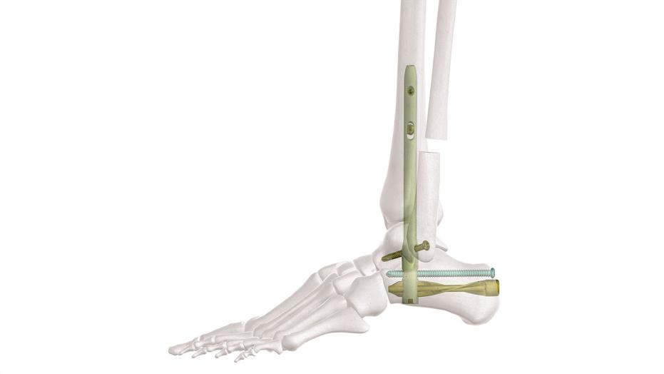 The Hindfoot Arthrodesis Nail shown in foot bone side view