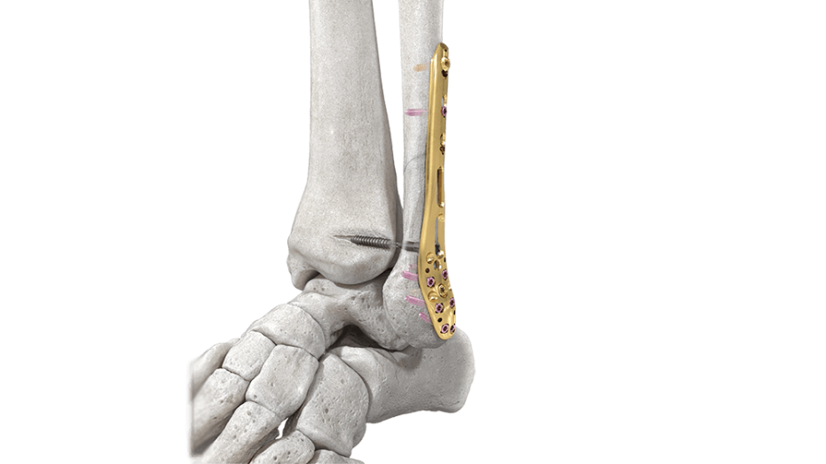 Variable Angle LCP Ankle Trauma System shown with distal tibia plate in ankle bone