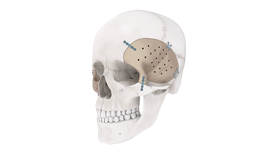 TRUMATCH PEEK Milled Cranial Implant shown implanted in left side of human skull
