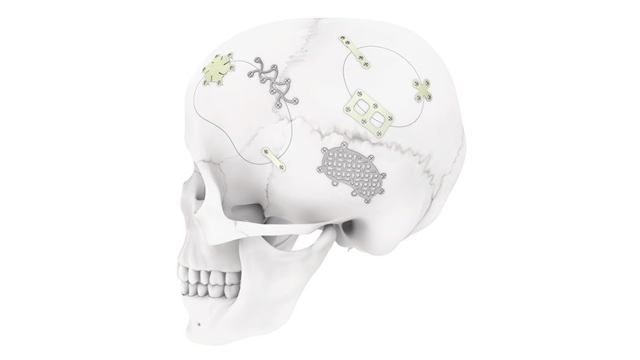 MatrixNEURO System implants shown on human skull