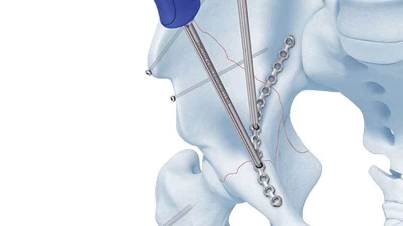 Low profile pelvic system being installed onto pelvis bone