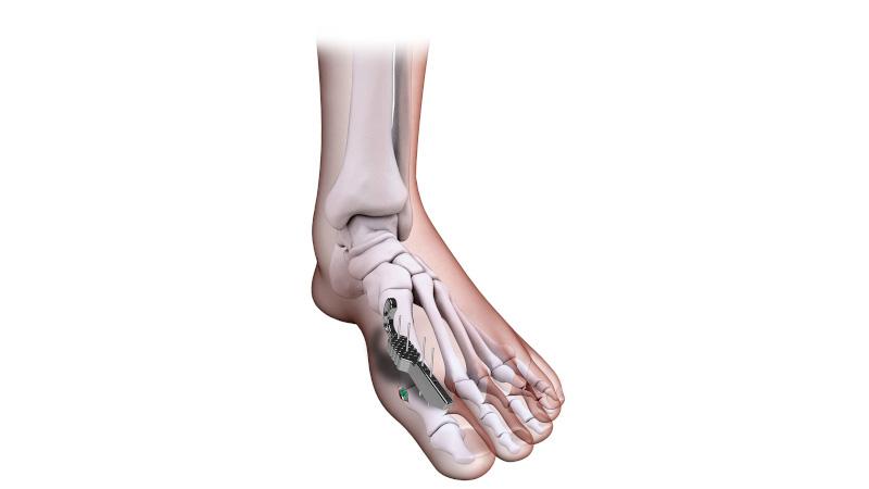 MINIBUNION™ 3D System