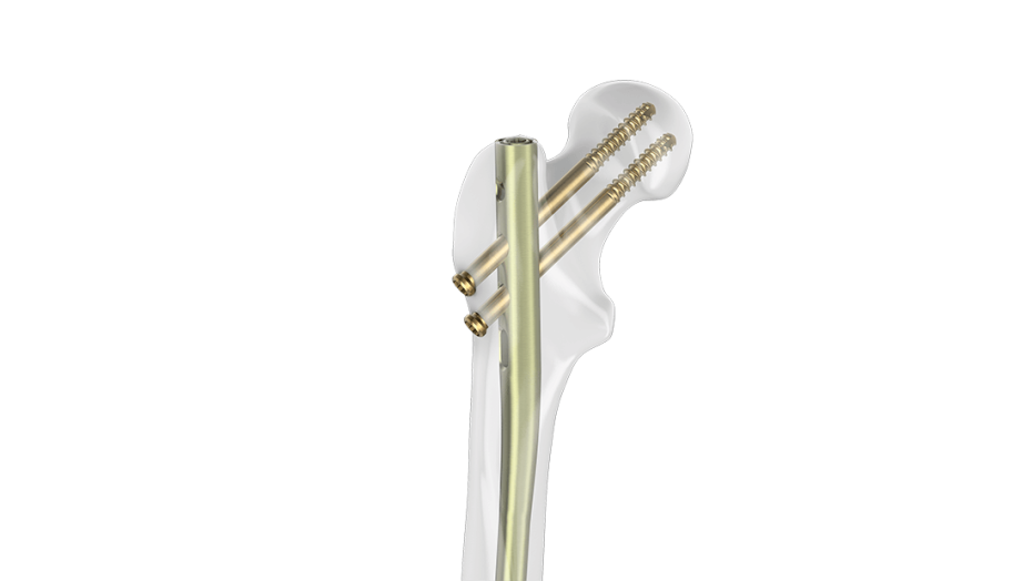FRN-ADVANCED Femoral Nailing System shown up close inserted in place in femur