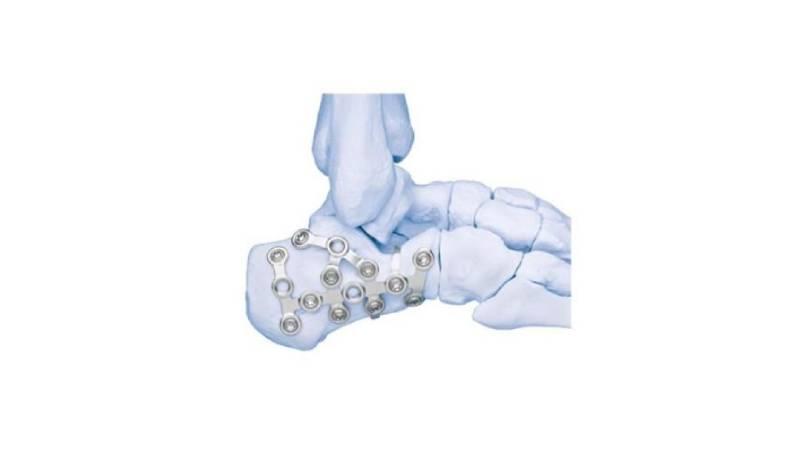 Locking calcaneal plates attached to foot