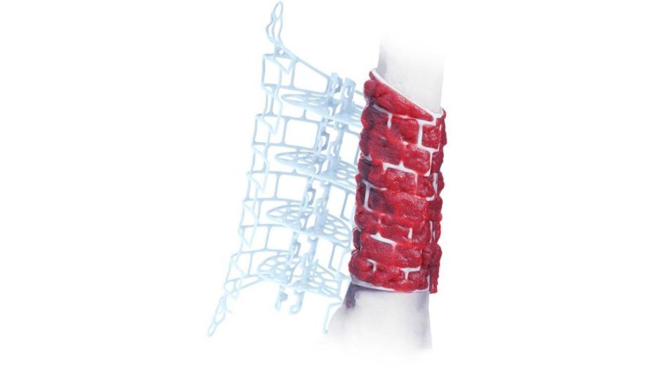 TRUMATCH Graft Cage applied to bone