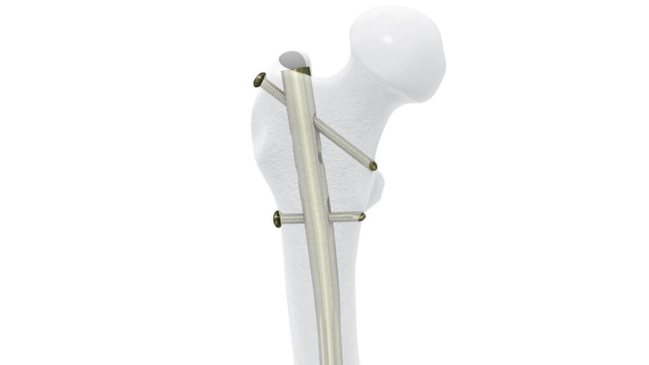 Cannulated Lateral Entry Femoral Recon Nail shown in place in femur