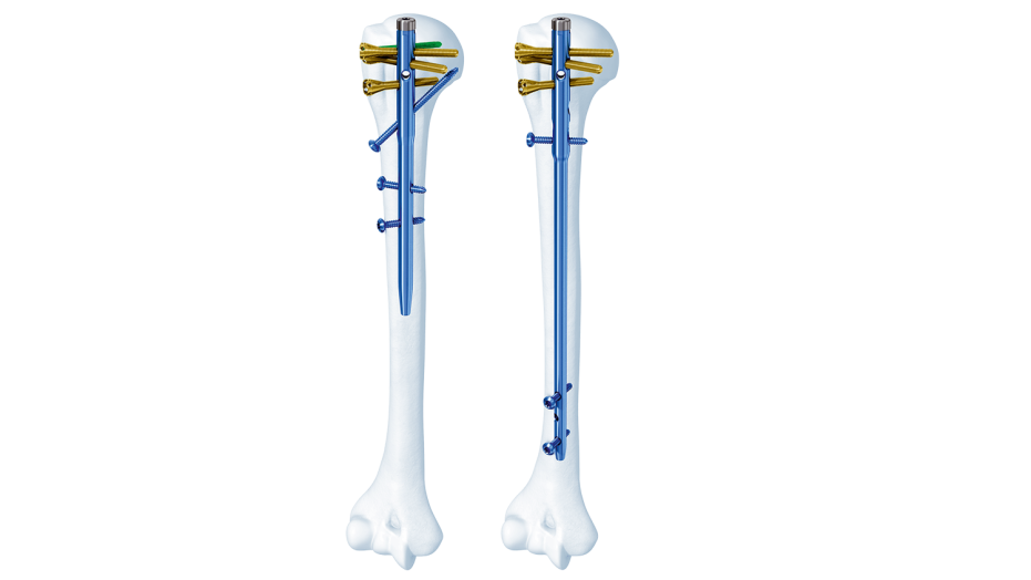 MultiLoc Humeral Nailing System seen inside of bone