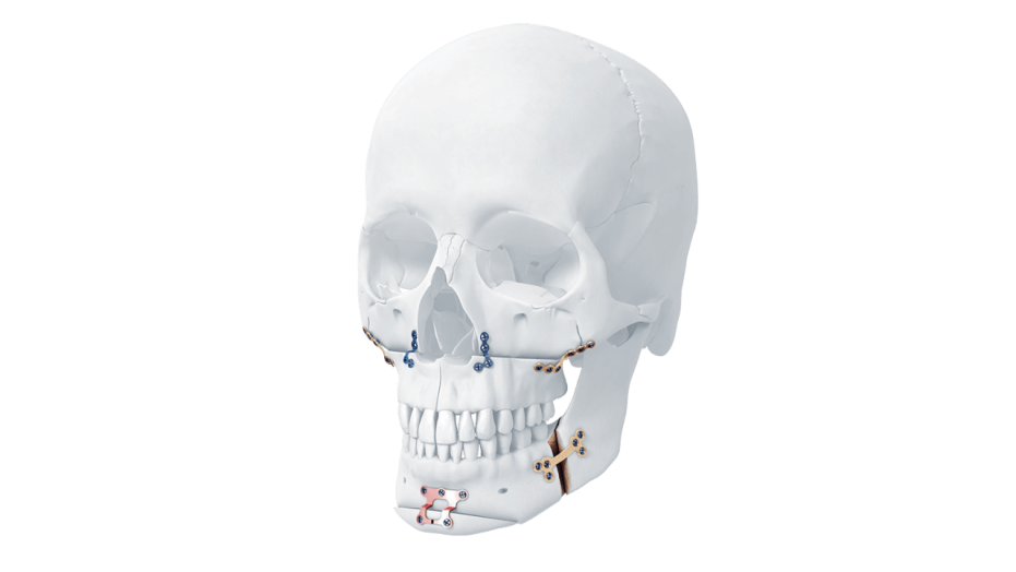 MatrixORTHOGNATHIC™ System 