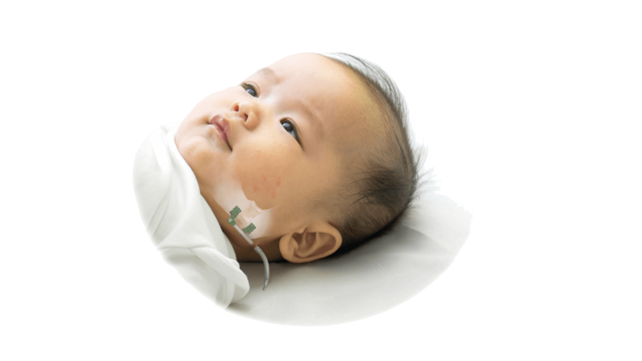 Craniomaxillifacial Distraction system shown on baby