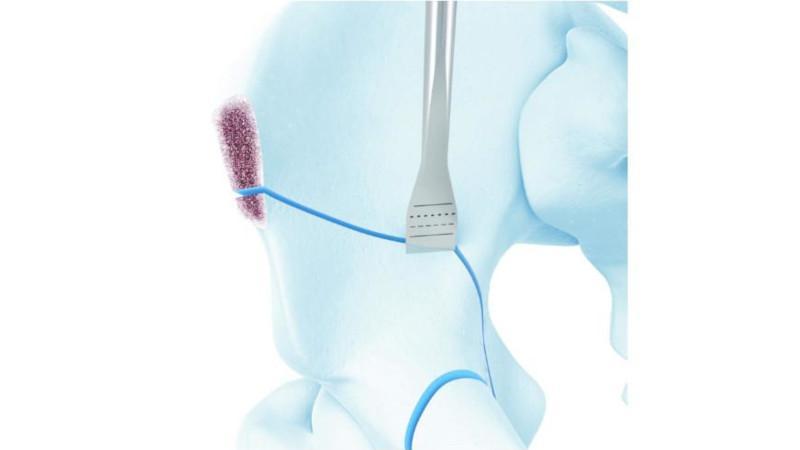 Hip osteotome against hip bone