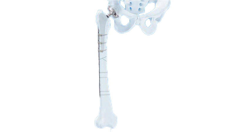 The LCP Periprosthetic System shown in place in the hip and femur bone