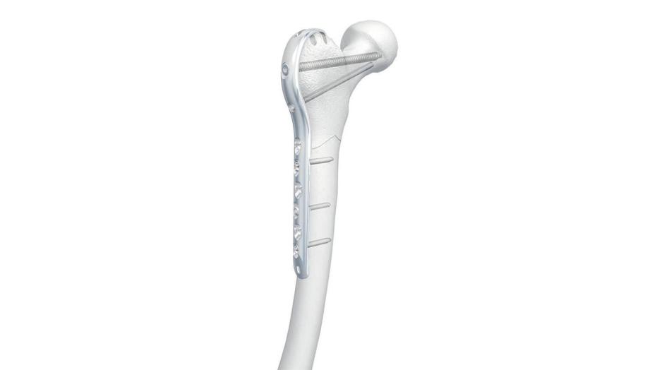 LCP Proximal Femur Hook Plate shown attached to bone with screws