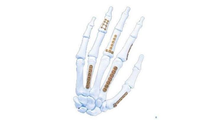 Modular Hand System shown in multiple areas of the bones of the hand