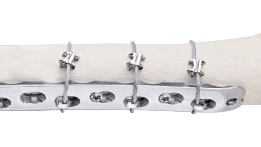The Orthopaedic Cable System shown in place on human bone