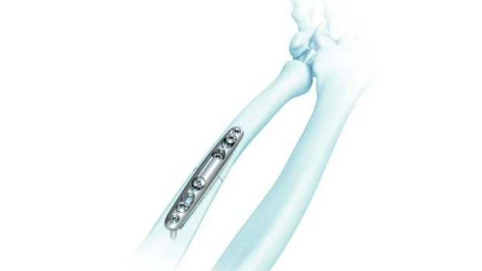 LCP Ulna Osteotomy System plate shown screwed into bone