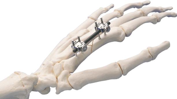 Mini External Fixator shown in place and attached to bones of hand