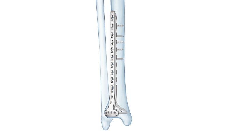 LCP Distal Tibia T-Plate attached to tibia