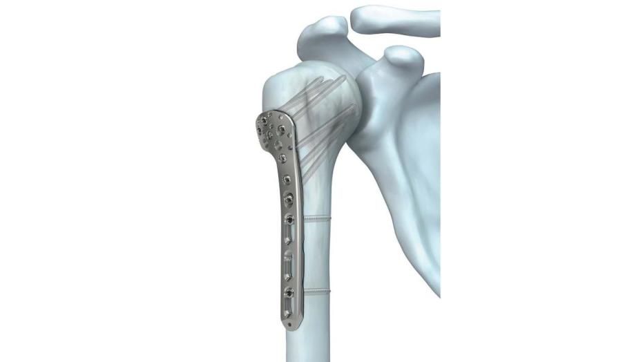 LCP Periarticular Proximal Humerus Plate shown in place in proximal humerus bone 
