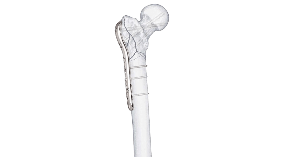 LCP Proximal Femur Plate attached to femur