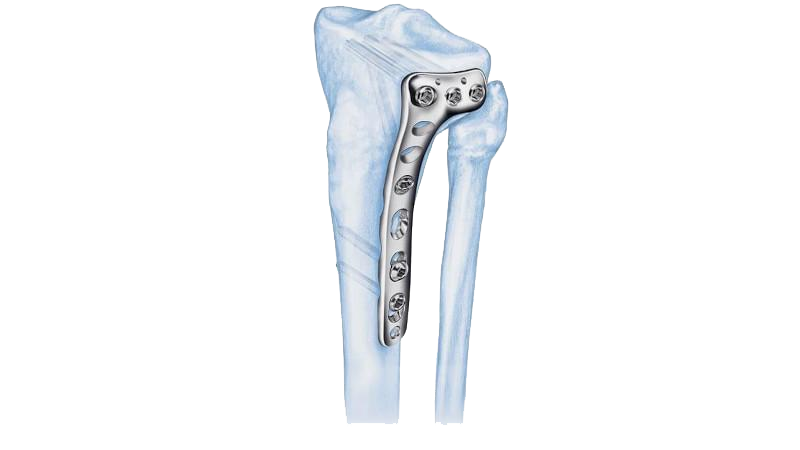 The LCP Proximal Tibia Plate in size 4.5 mm shown affixed to bone