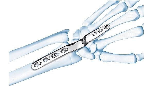 LCP Wrist Fusion Set shown attached to bones of wrist and hand