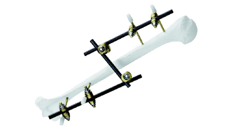 Medium External Fixator attached to bone