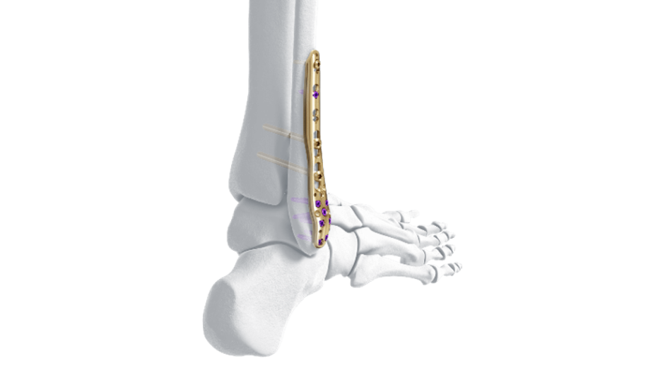LCP Distal Fibula Plate attached to bone