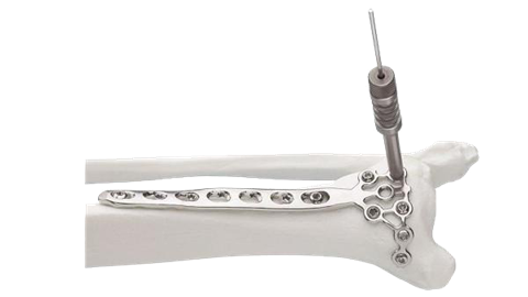 LCP Pilon Plate shown being screwed into the distal tibia
