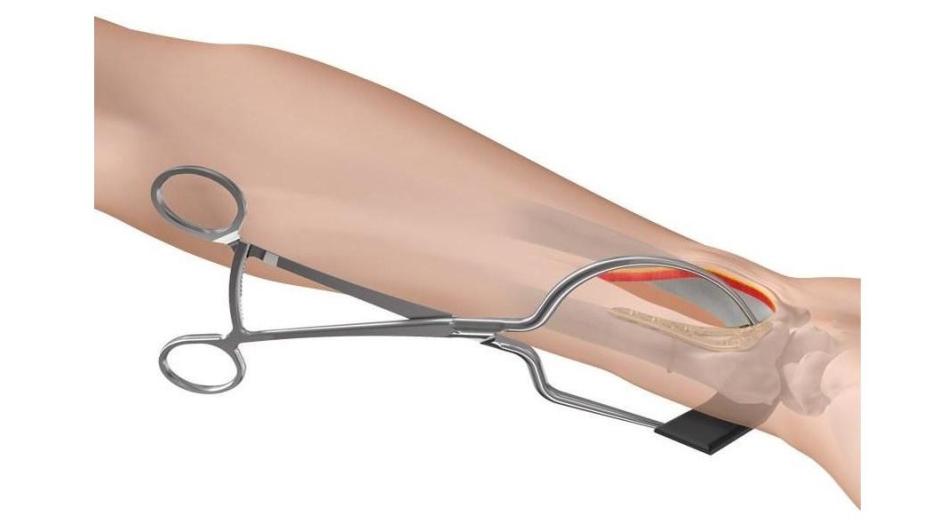 Soft Tissue Bone Reduction Forceps shown clamping the distal radius during surgery