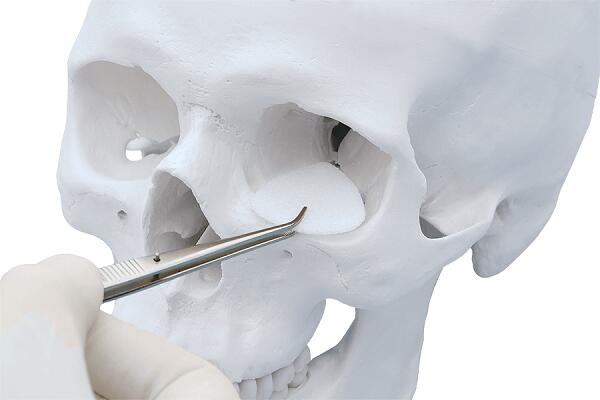 SYNPOR Porous Polyethylene Implants on human skull.