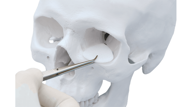SYNPOR Porous Polyethylene Implants on human skull.