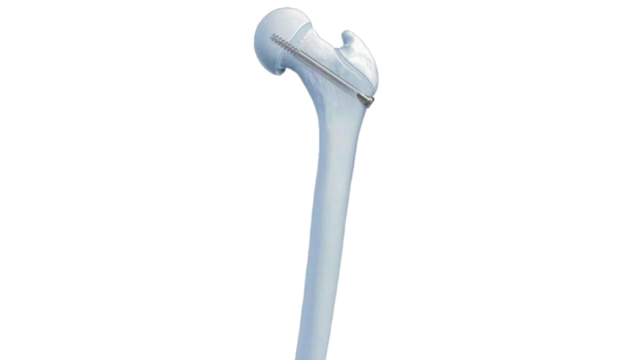 Slipped Capital Femoral Epiphysis Screw shown fixated in bone