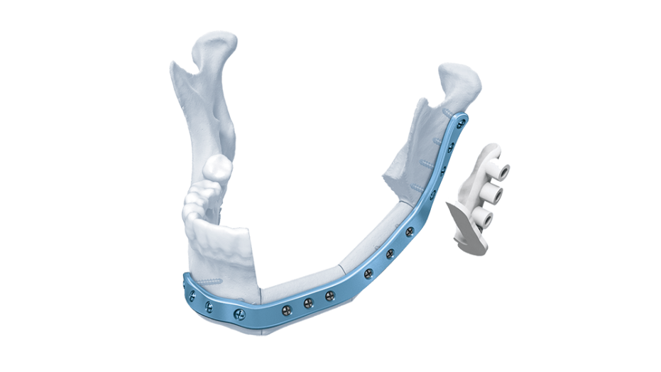 TRUMATCH CMF Titanium 3D Milled Plates for Mandible shown in place attached to human mandible bone and the matching surgical guide*