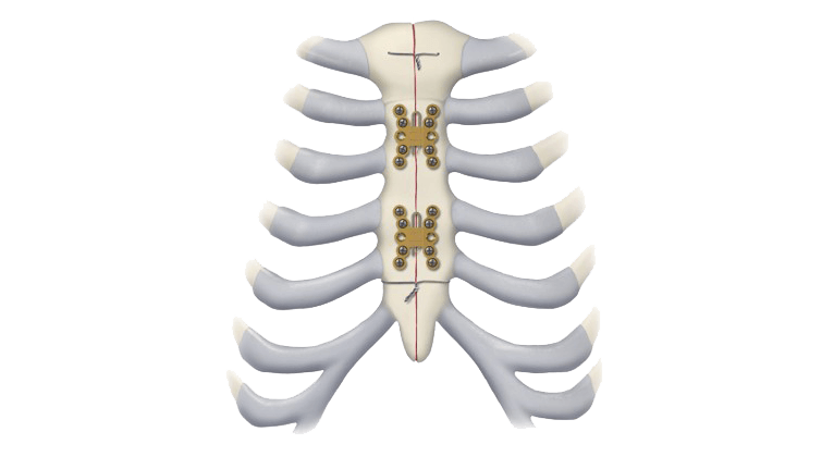Sternal closure construct using the Titanium Sternal Fixation System